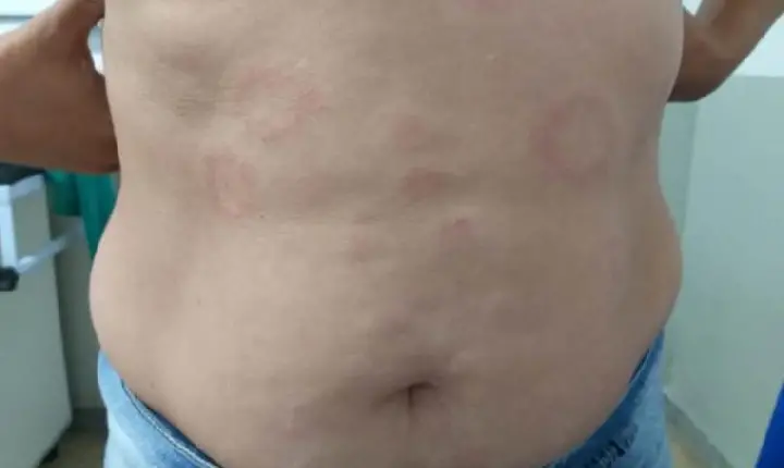 Doença que pode causar deformidades irreversíveis já contaminou 414 tocantinenses em 2022